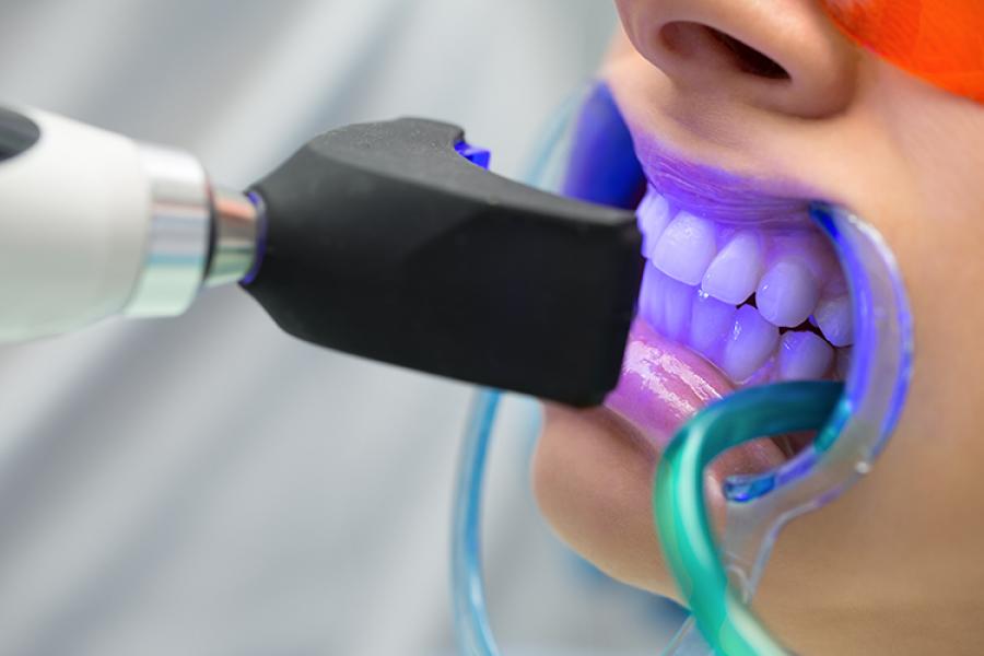 Diş Beyazlatma Tedavisi